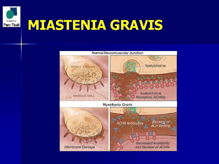 MIASTENIA GRAVIS 