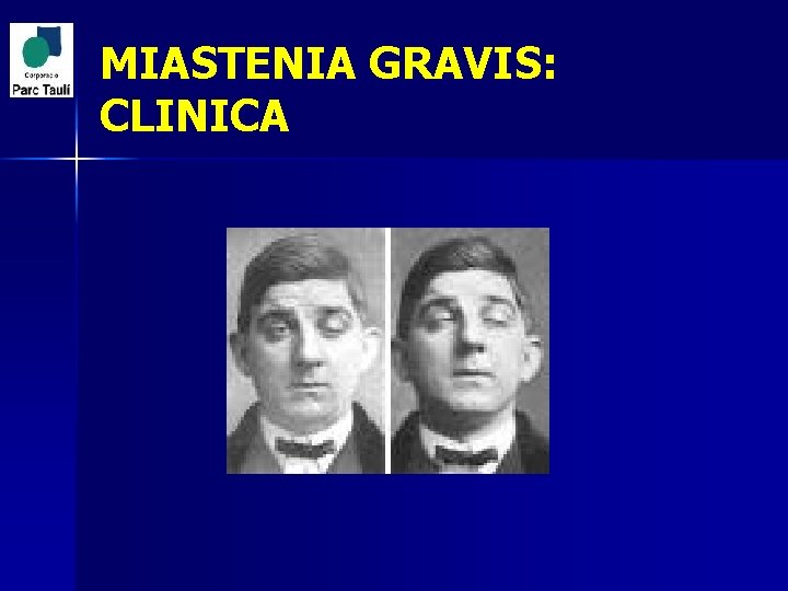 MIASTENIA GRAVIS: CLINICA 