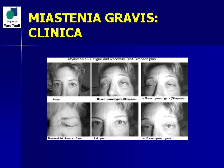 MIASTENIA GRAVIS: CLINICA 