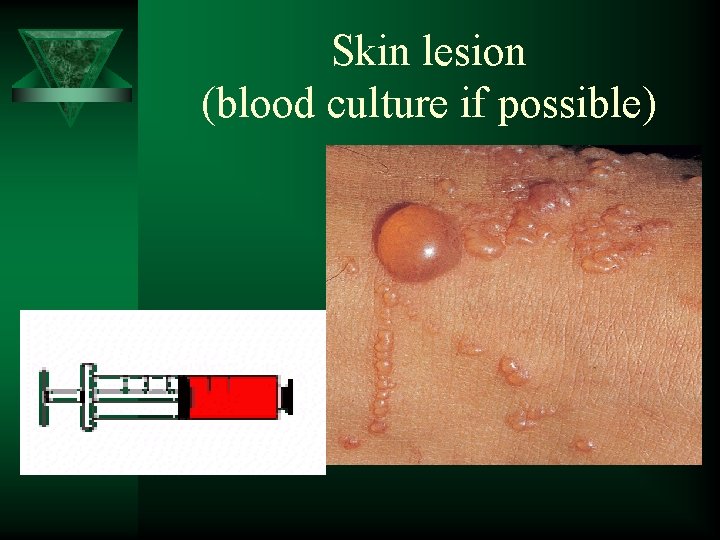 Skin lesion (blood culture if possible) 