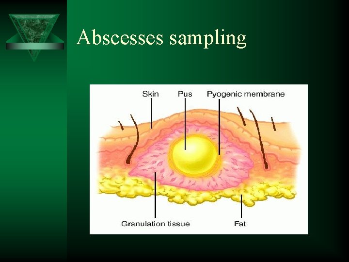 Abscesses sampling 