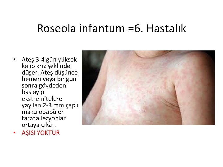 Roseola infantum =6. Hastalık • Ateş 3 -4 gün yüksek kalıp kriz şeklinde düşer.