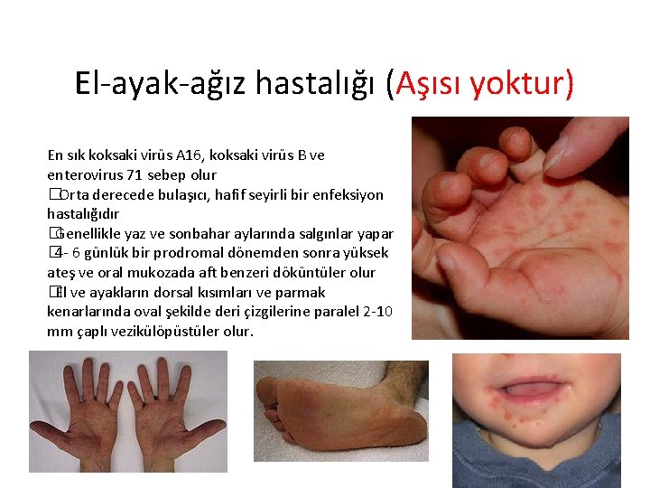El-ayak-ağız hastalığı (Aşısı yoktur) En sık koksaki virüs A 16, koksaki virüs B ve