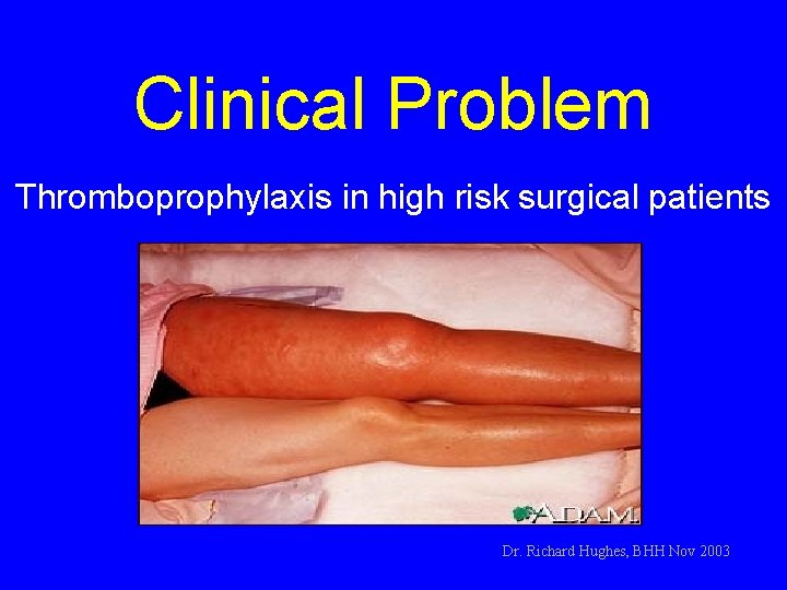 Clinical Problem Thromboprophylaxis in high risk surgical patients Dr. Richard Hughes, BHH Nov 2003