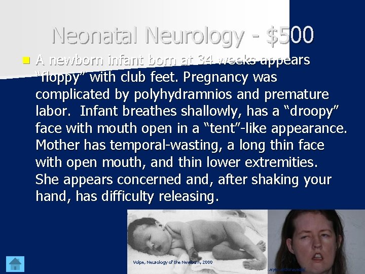 Neonatal Neurology - $500 n A newborn infant born at 34 weeks appears “floppy”