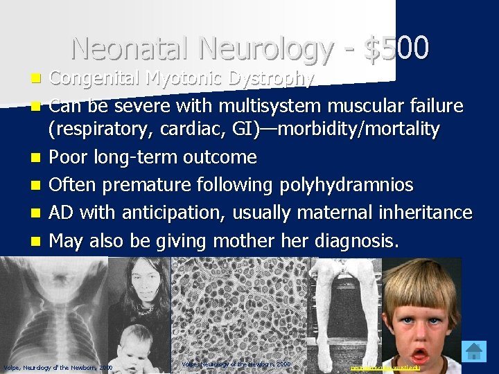 Neonatal Neurology - $500 n n n Congenital Myotonic Dystrophy Can be severe with