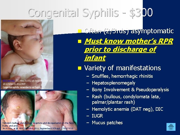 Congenital Syphilis - $300 n Often (2/3 rds) asymptomatic n Must know mother’s RPR