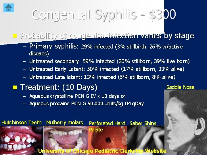 Congenital Syphilis - $300 n Probability of congenital infection varies by stage – Primary