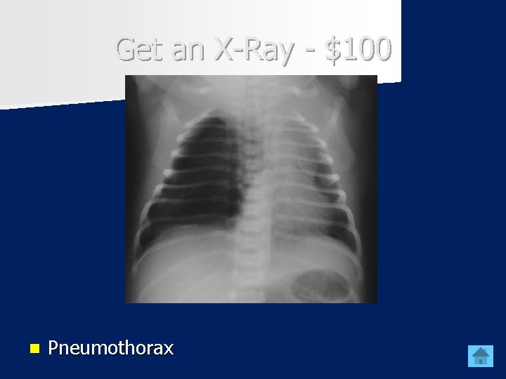 Get an X-Ray - $100 n Pneumothorax 