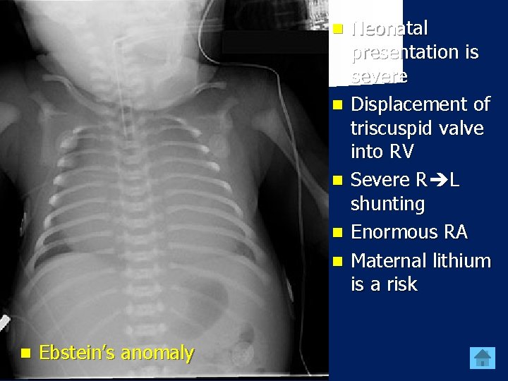 n n n Ebstein’s anomaly Neonatal presentation is severe Displacement of triscuspid valve into