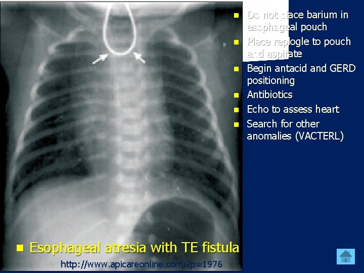 n n n n Esophageal atresia with TE fistula http: //www. apicareonline. com/? p=1976