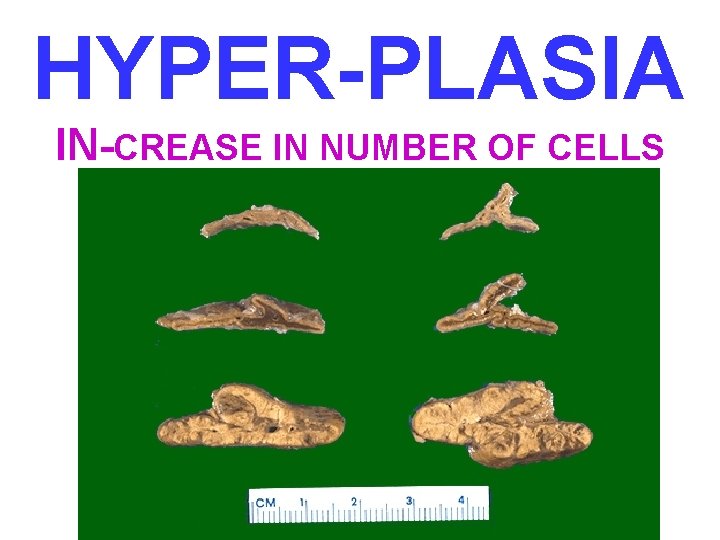 HYPER-PLASIA IN-CREASE IN NUMBER OF CELLS 