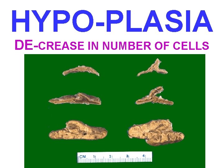 HYPO-PLASIA DE-CREASE IN NUMBER OF CELLS 