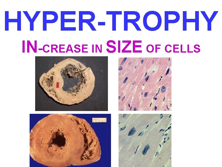 HYPER-TROPHY IN-CREASE IN SIZE OF CELLS 