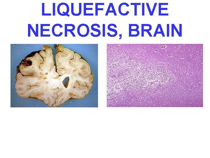 LIQUEFACTIVE NECROSIS, BRAIN 