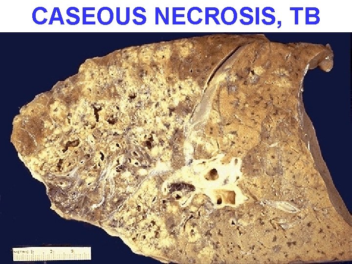 CASEOUS NECROSIS, TB 