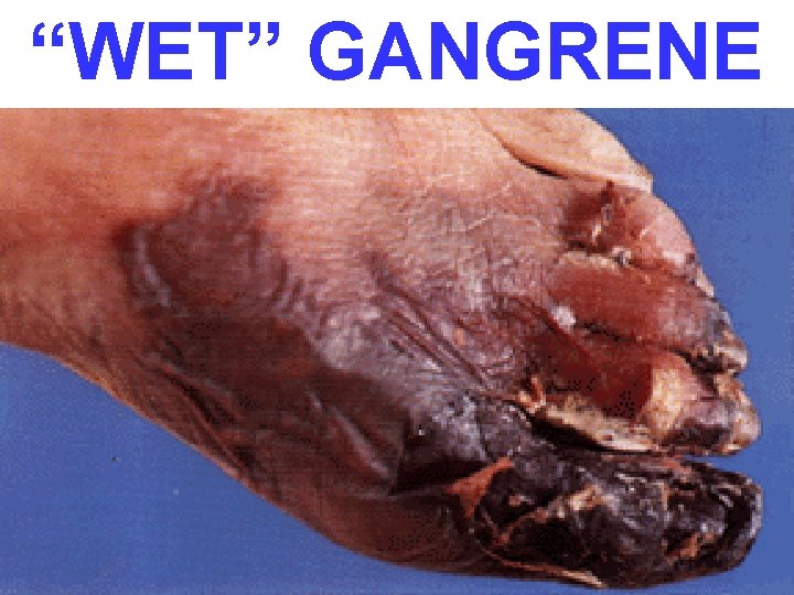 “WET” GANGRENE 