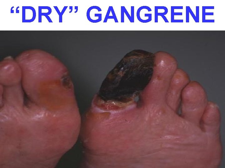 “DRY” GANGRENE 