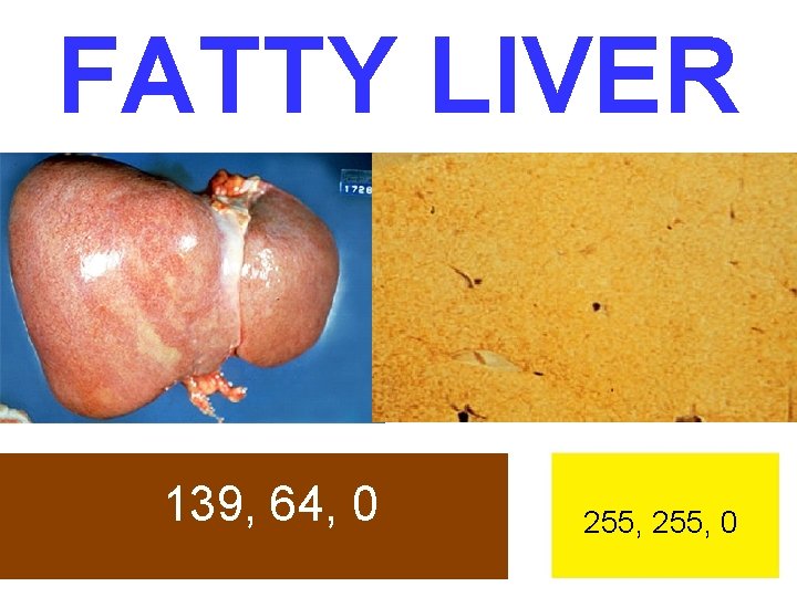 FATTY LIVER 139, 64, 0 255, 0 