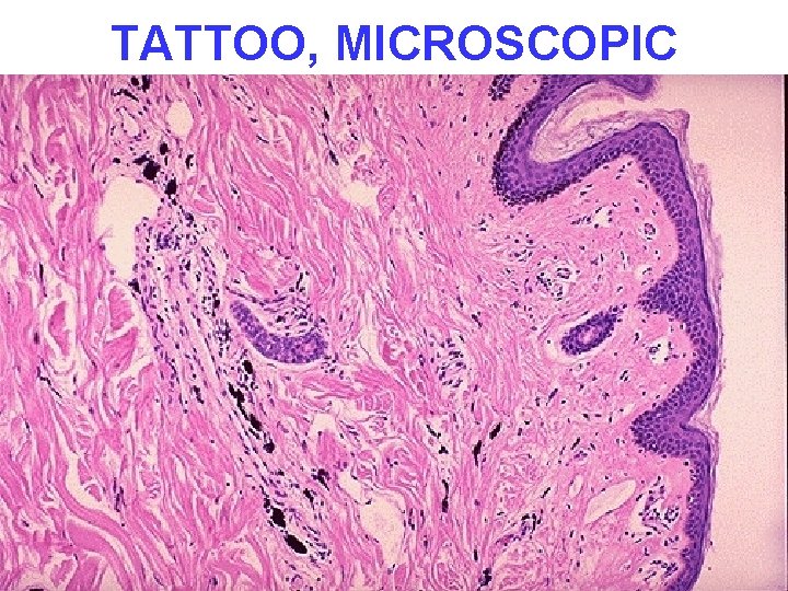 TATTOO, MICROSCOPIC 