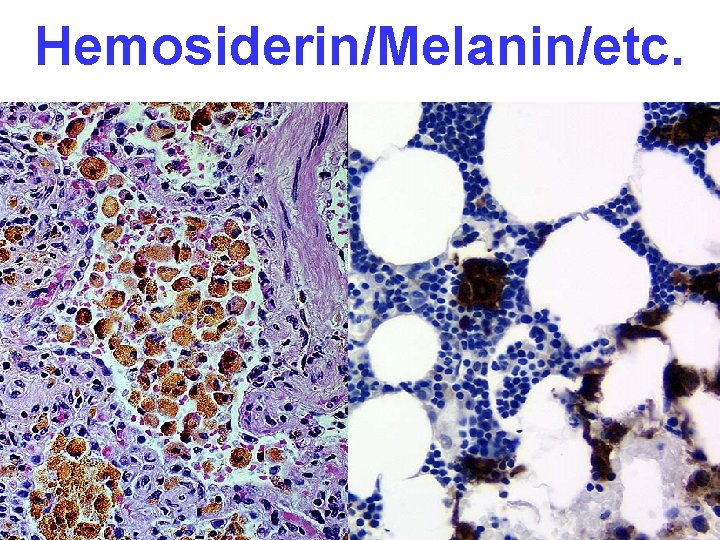 Hemosiderin/Melanin/etc. 