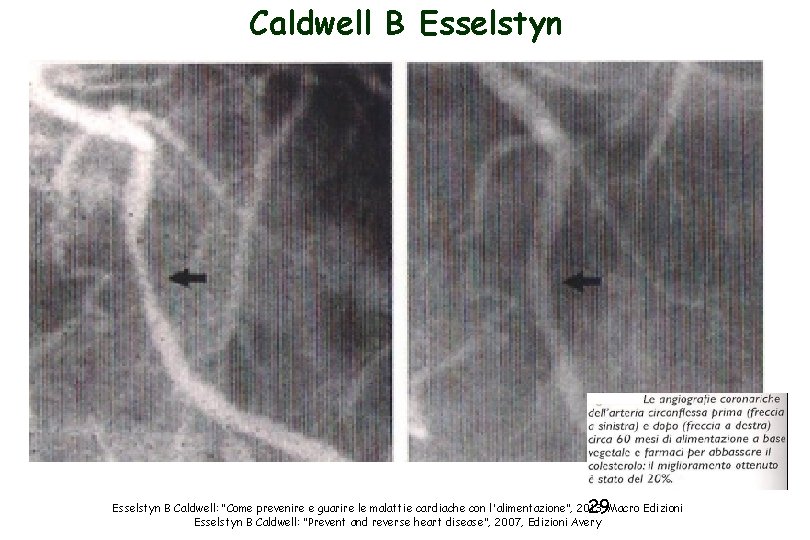 Caldwell B Esselstyn 29 Esselstyn B Caldwell: “Come prevenire e guarire le malattie cardiache