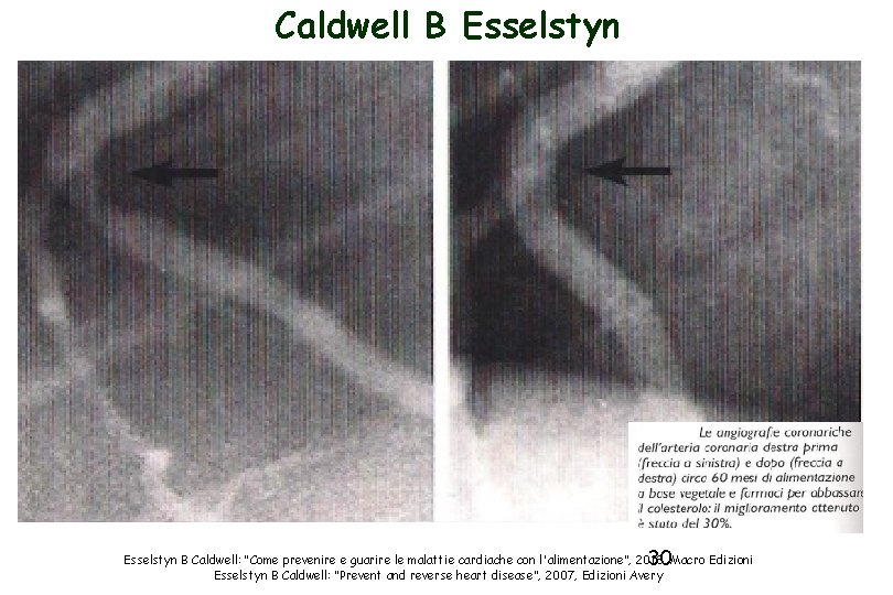 Caldwell B Esselstyn 30 Esselstyn B Caldwell: “Come prevenire e guarire le malattie cardiache