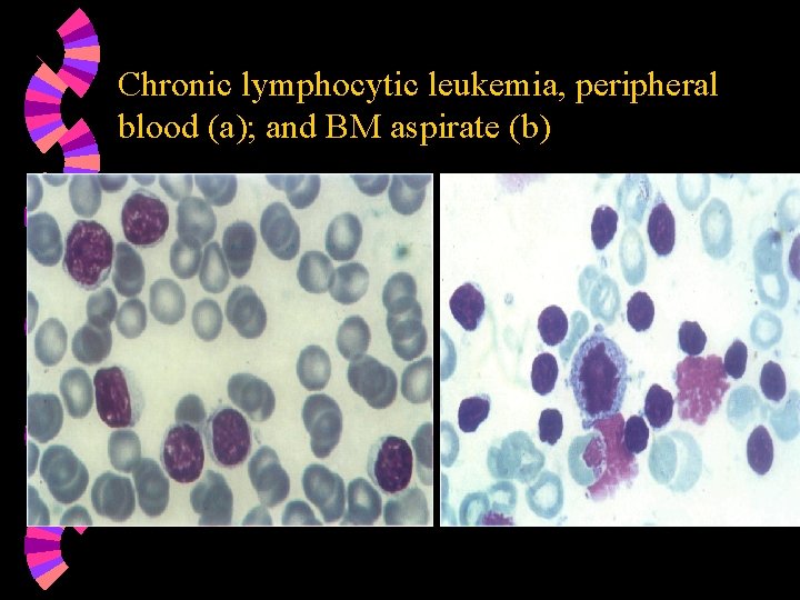 Chronic lymphocytic leukemia, peripheral blood (a); and BM aspirate (b) 