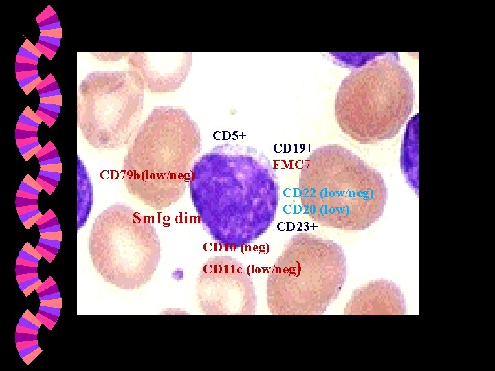 CD 5+ CD 79 b(low/neg) CD 19+ FMC 7 CD 22 (low/neg) CD 20