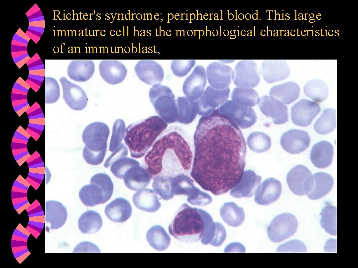 Richter's syndrome; peripheral blood. This large immature cell has the morphological characteristics of an