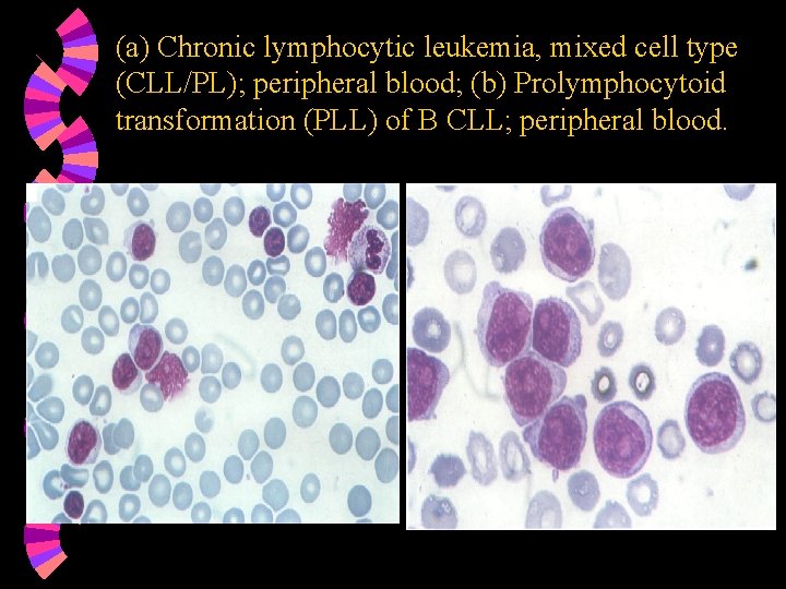 (a) Chronic lymphocytic leukemia, mixed cell type (CLL/PL); peripheral blood; (b) Prolymphocytoid transformation (PLL)