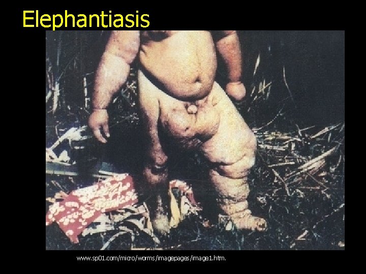 Elephantiasis www. sp 01. com/micro/worms/imagepages/image 1. htm. 