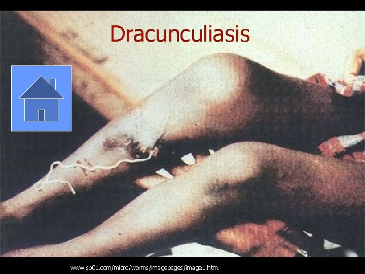 Dracunculiasis www. sp 01. com/micro/worms/imagepages/image 1. htm. 