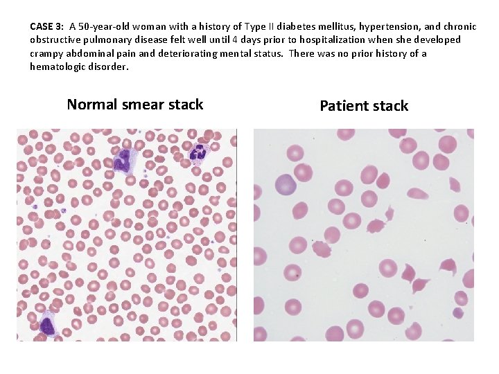 CASE 3: A 50 -year-old woman with a history of Type II diabetes mellitus,