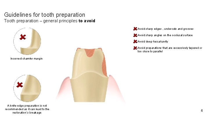 Guidelines for tooth preparation Tooth preparation – general principles to avoid Avoid sharp edges