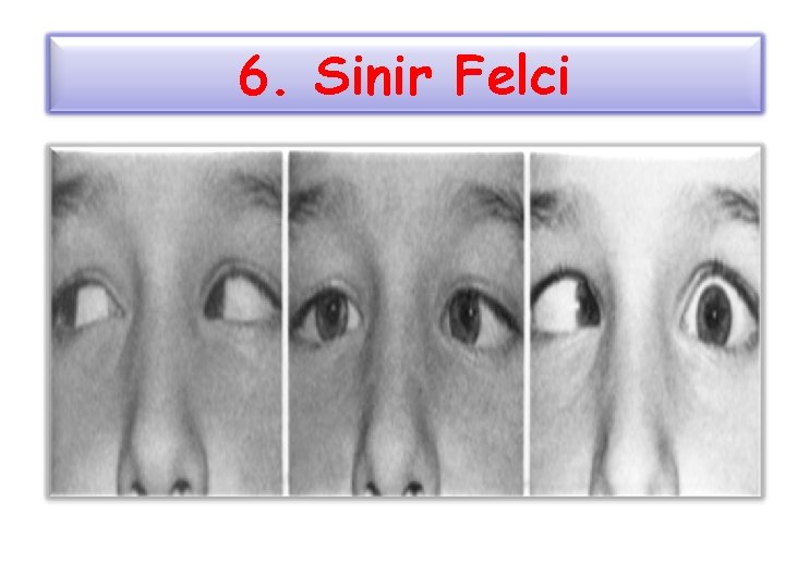 6. Sinir Felci 