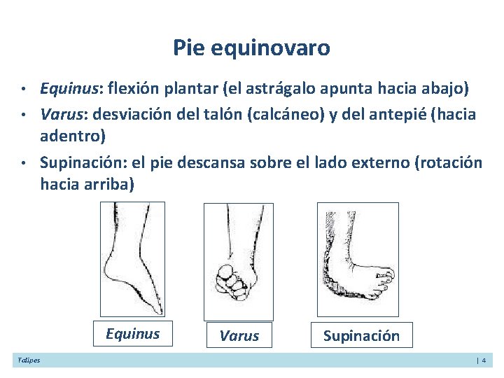 Pie equinovaro • • • Equinus: flexión plantar (el astrágalo apunta hacia abajo) Varus: