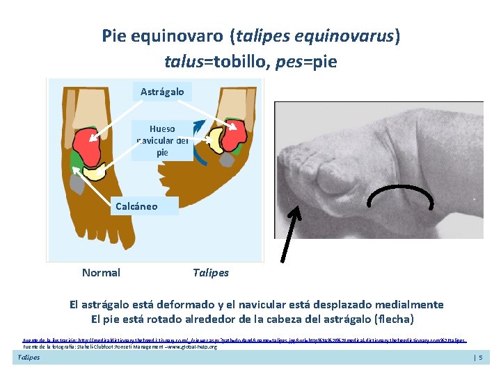 Pie equinovaro (talipes equinovarus) talus=tobillo, pes=pie Astrágalo Hueso navicular del pie Calcáneo Normal Talipes