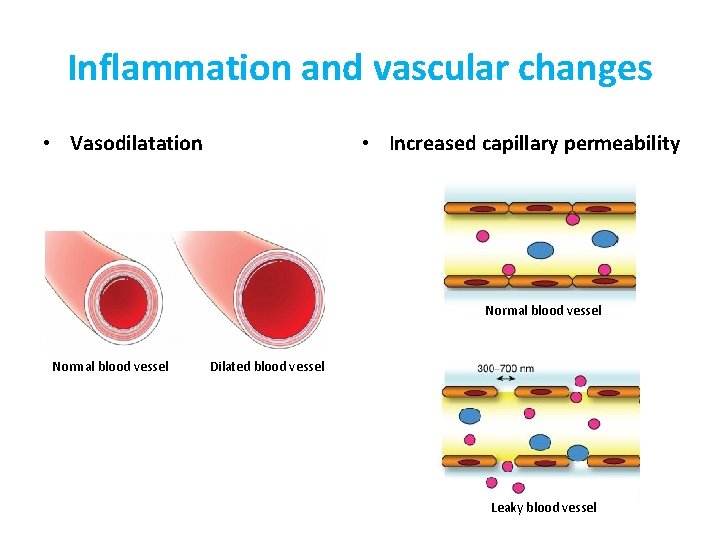 Inflammation and vascular changes • Vasodilatation • Increased capillary permeability Normal blood vessel Dilated