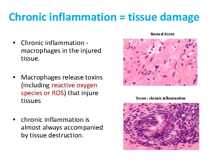 Chronic inflammation = tissue damage Normal tissue • Chronic inflammation - macrophages in the