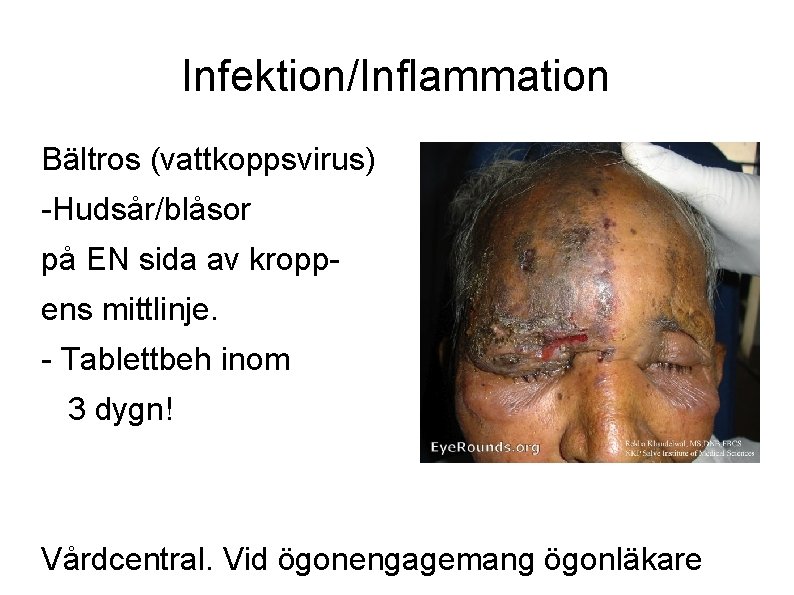 Infektion/Inflammation Bältros (vattkoppsvirus) -Hudsår/blåsor på EN sida av kroppens mittlinje. - Tablettbeh inom 3