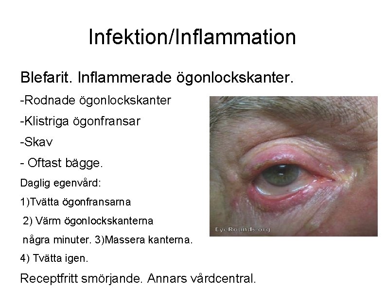 Infektion/Inflammation Blefarit. Inflammerade ögonlockskanter. -Rodnade ögonlockskanter -Klistriga ögonfransar -Skav - Oftast bägge. Daglig egenvård: