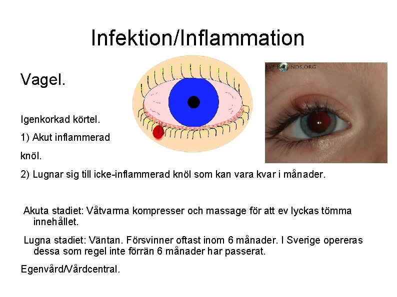 Infektion/Inflammation Vagel. Igenkorkad körtel. 1) Akut inflammerad knöl. 2) Lugnar sig till icke-inflammerad knöl