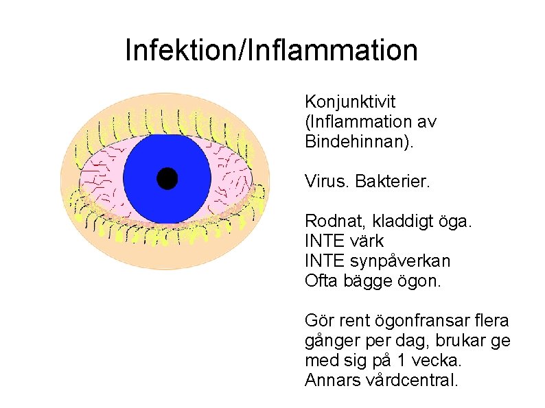 Infektion/Inflammation Konjunktivit (Inflammation av Bindehinnan). Virus. Bakterier. Rodnat, kladdigt öga. INTE värk INTE synpåverkan