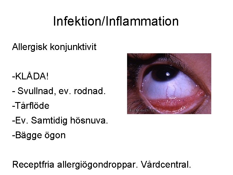 Infektion/Inflammation Allergisk konjunktivit -KLÅDA! - Svullnad, ev. rodnad. -Tårflöde -Ev. Samtidig hösnuva. -Bägge ögon