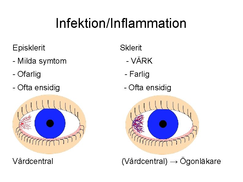 Infektion/Inflammation Episklerit Sklerit - Milda symtom - VÄRK - Ofarlig - Farlig - Ofta