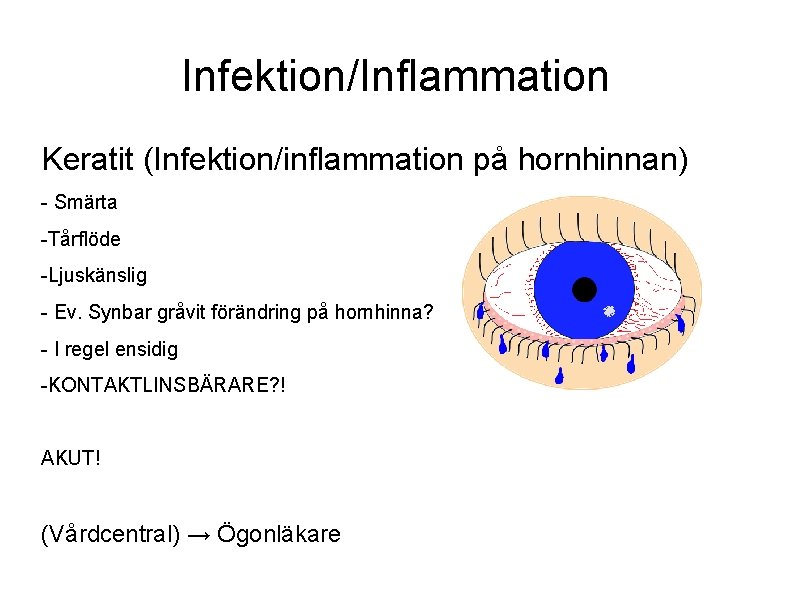 Infektion/Inflammation Keratit (Infektion/inflammation på hornhinnan) - Smärta -Tårflöde -Ljuskänslig - Ev. Synbar gråvit förändring