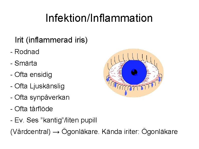 Infektion/Inflammation Irit (inflammerad iris) - Rodnad - Smärta - Ofta ensidig - Ofta Ljuskänslig