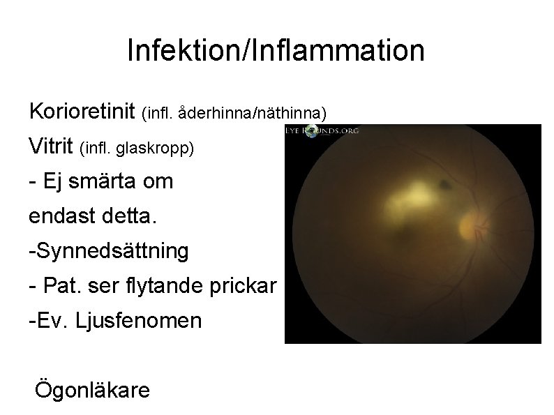 Infektion/Inflammation Korioretinit (infl. åderhinna/näthinna) Vitrit (infl. glaskropp) - Ej smärta om endast detta. -Synnedsättning
