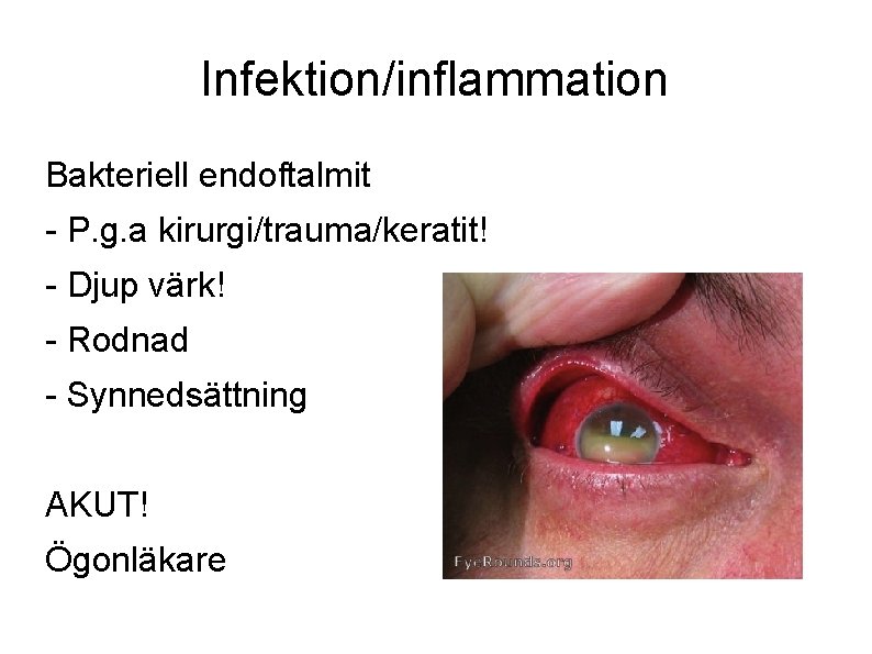 Infektion/inflammation Bakteriell endoftalmit - P. g. a kirurgi/trauma/keratit! - Djup värk! - Rodnad -